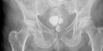 Bladder stones are hard masses of minerals in your bladder. They foster when the minerals in concentrated pee solidify and structure stones.