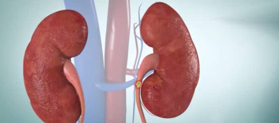 Kidney Stone Treatment in Sangamner